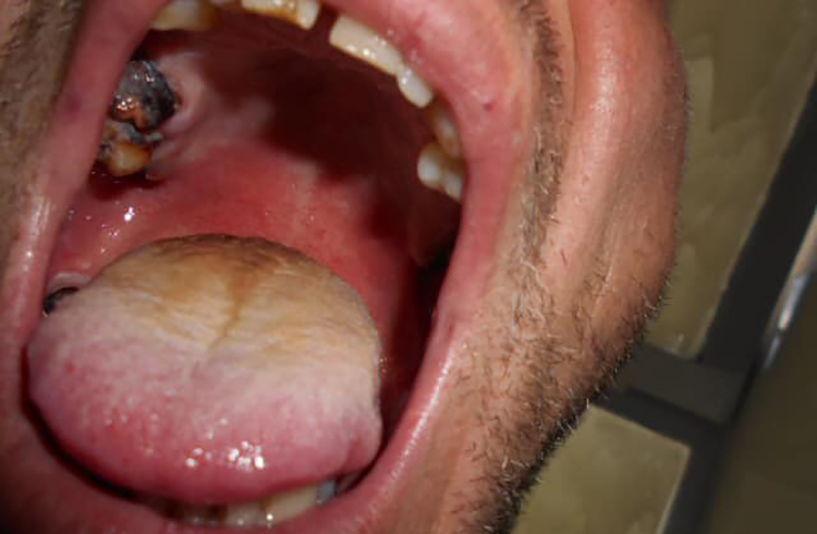 Një person tentoi të fuste drogë në burg duke e fshehur në gojë