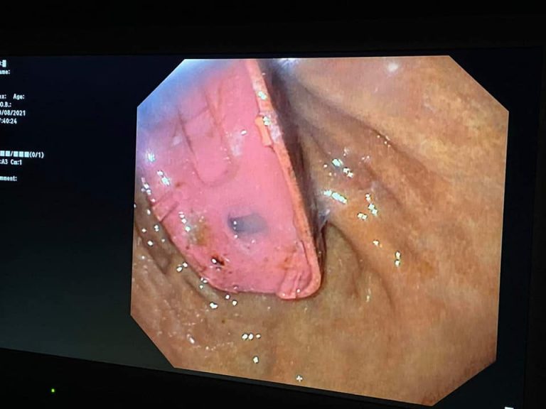 Flet mjeku që ia hoqi 33-vjeçarit telefonin nga barku: Kishte rrezik të shpërthente bateria