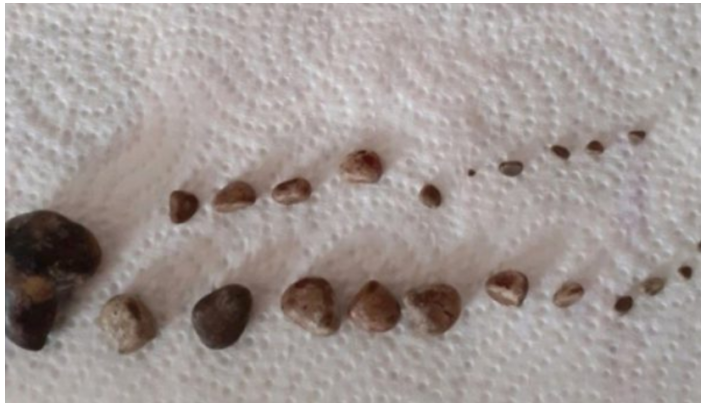 52-vjeçarit në QKUK i hiqen më shumë se 20 gurë në veshkë