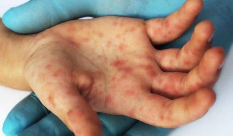 Gripi i domateve shpërthen në Indi